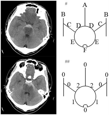 Clinical outcome and prognostic factors of patients with non-traumatic angiography-negative subarachnoid hemorrhage